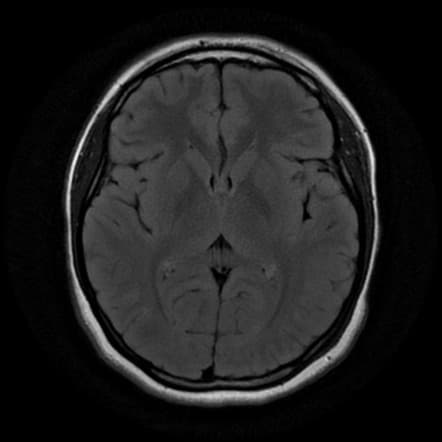 Detect Ischemic Stroke and Vessel Occlusion Using CTA and MRI Scans