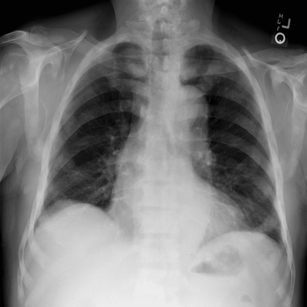 Detect Pneumothorax Using Chest X-ray Images