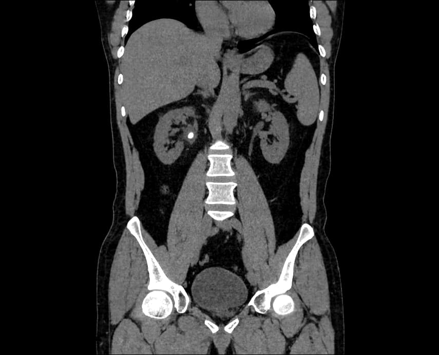 Segment Kidney Tumor from CT Images